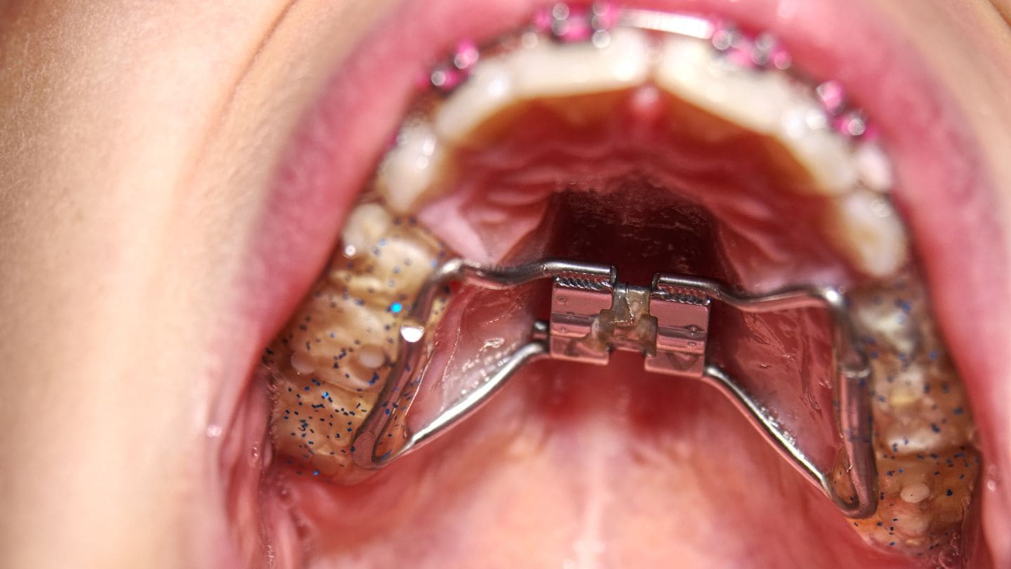 Disjoncteur palatin et QuadHelix